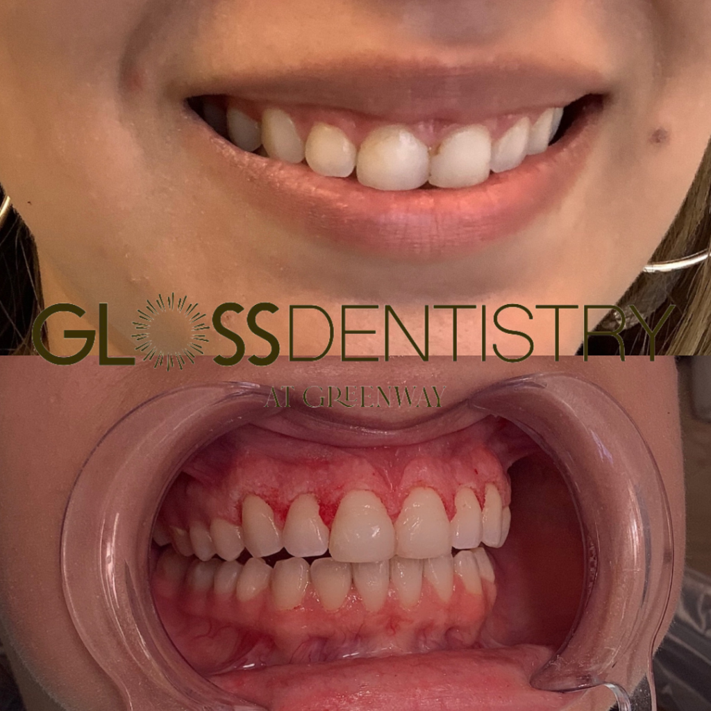Greenway Houston Dentist - gum bleaching Cosmetic Dentistry